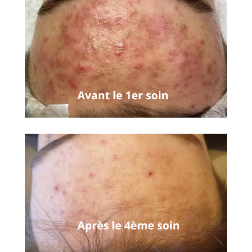 Résultat après 4 soins Equilibre Pureté, anti-imperfections, anti-boutons, de Guinot à Ergué Gabéric