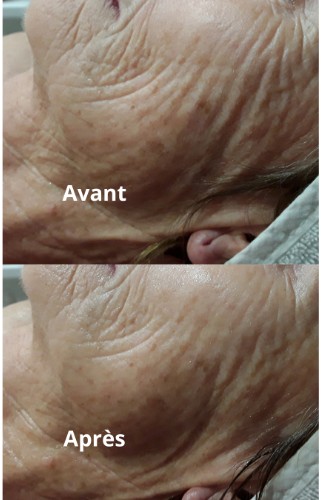 Avant/Après un soin Age Summum Guinot